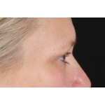 Eyelid Surgery Before & After Patient #2879
