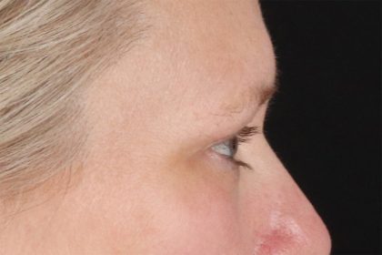 Eyelid Surgery Before & After Patient #2879