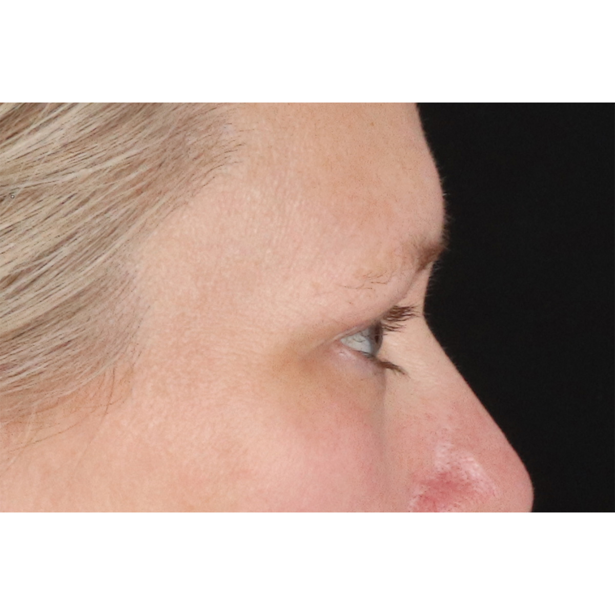 Eyelid Surgery Before & After Patient #2879