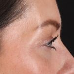 Eyelid Surgery Before & After Patient #2882