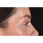 Eyelid Surgery Before & After Patient #2882