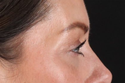 Eyelid Surgery Before & After Patient #2882