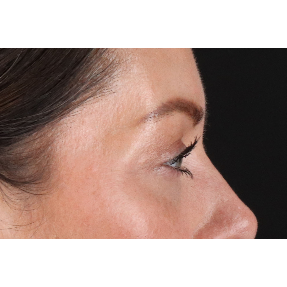 Eyelid Surgery Before & After Patient #2882