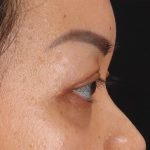 Eyelid Surgery Before & After Patient #2883