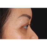 Eyelid Surgery Before & After Patient #2883