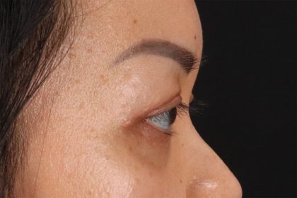 Eyelid Surgery Before & After Patient #2883