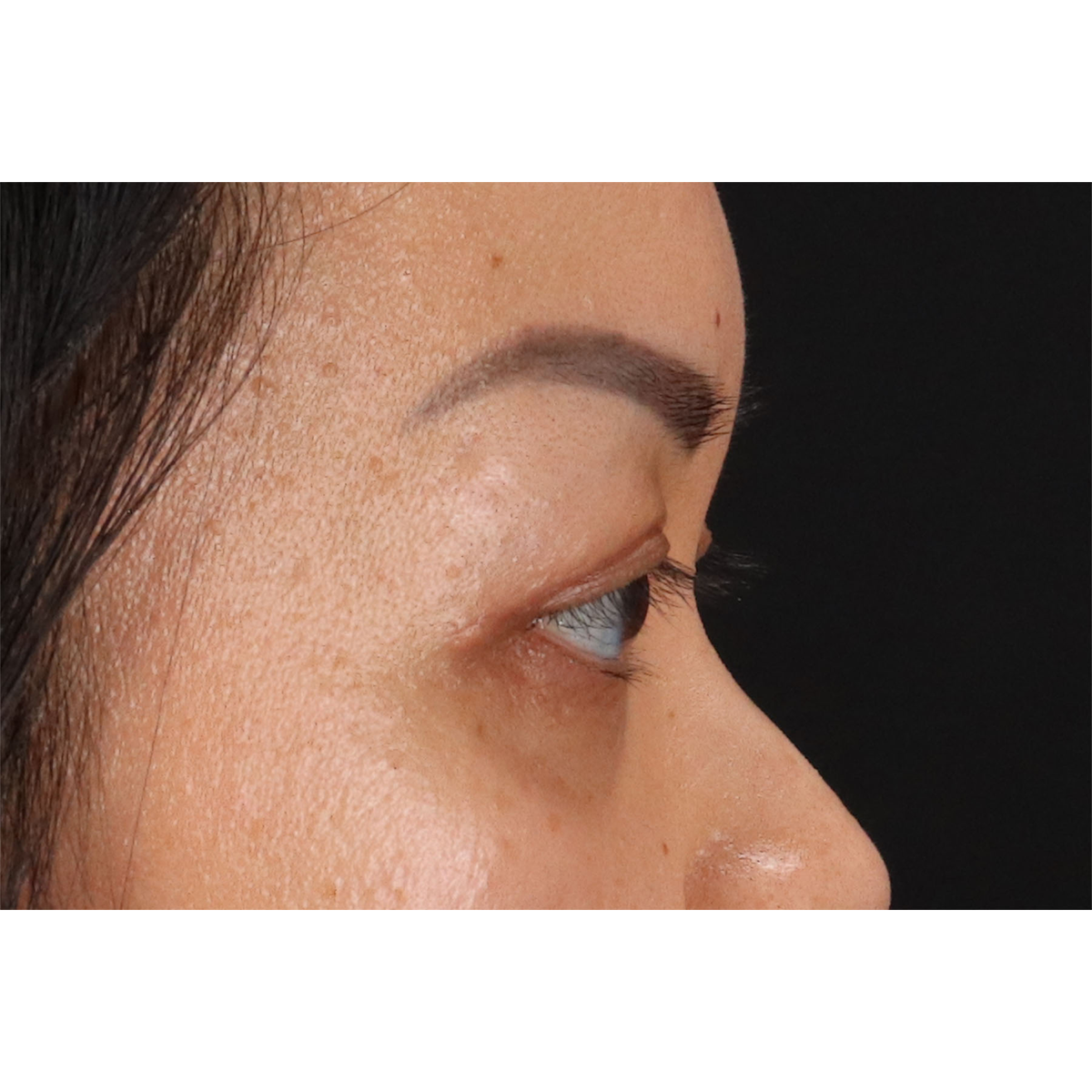 Eyelid Surgery Before & After Patient #2883