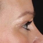 Eyelid Surgery Before & After Patient #2885