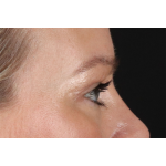 Eyelid Surgery Before & After Patient #2885