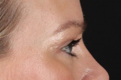 Eyelid Surgery Before & After Patient #2885