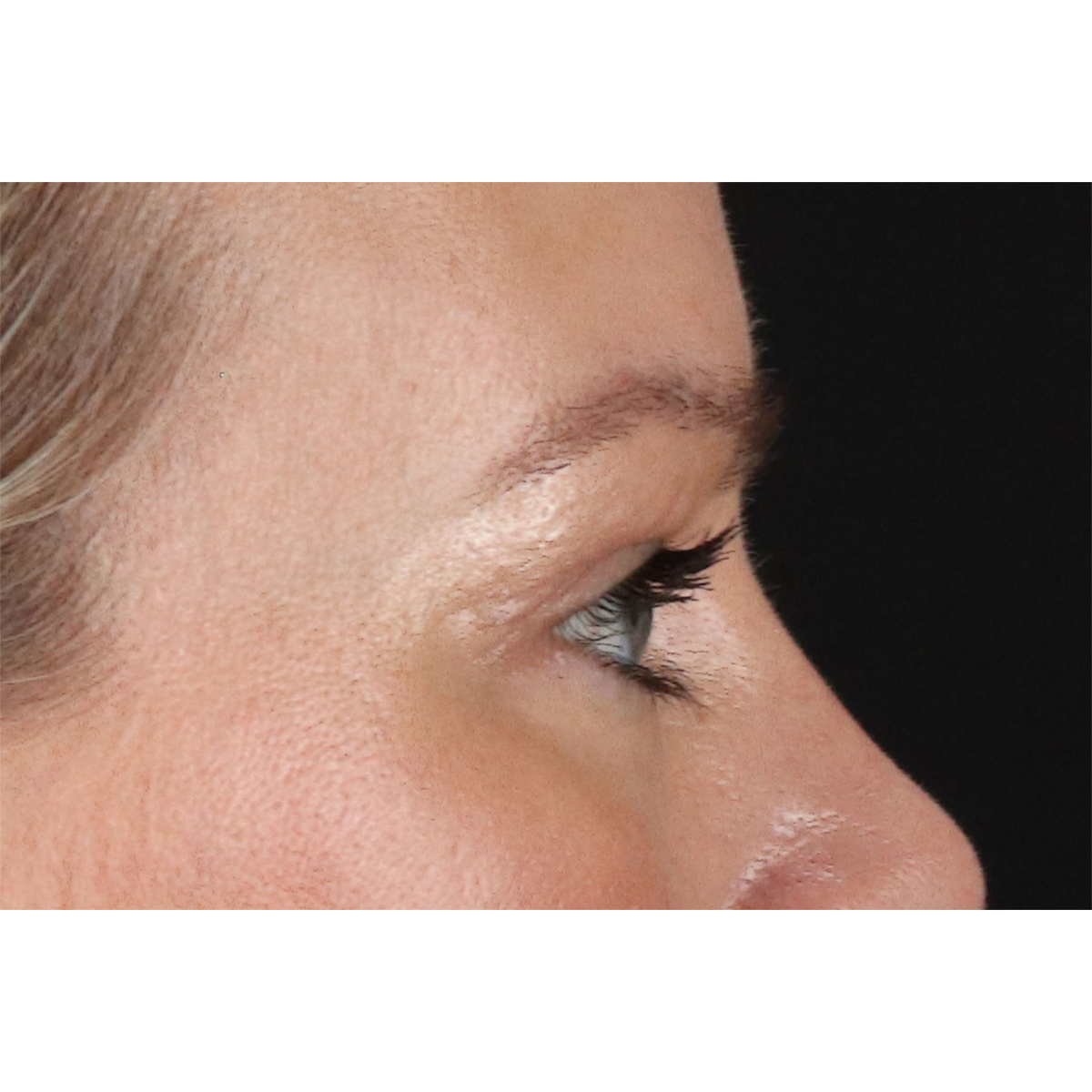 Eyelid Surgery Before & After Patient #2885