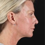 Structural Fat Grafting Before & After Patient #3650