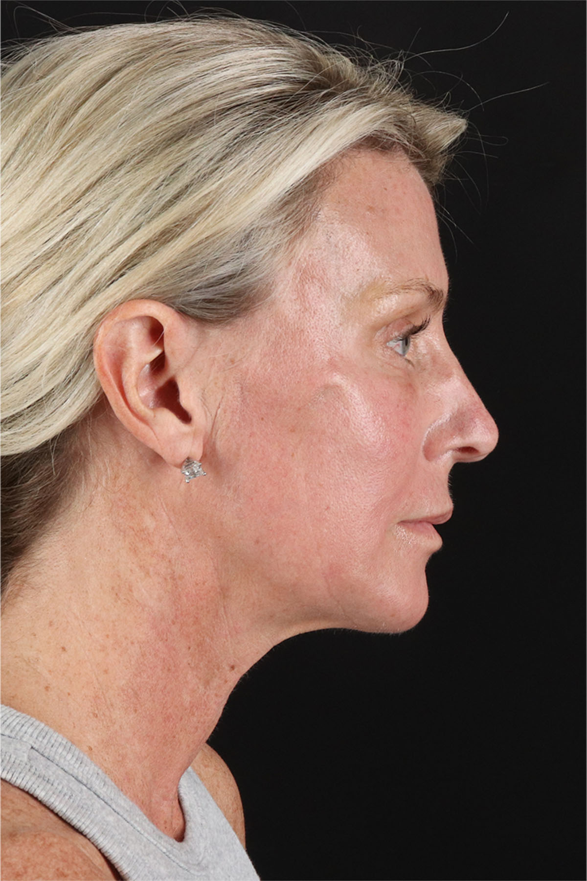 Structural Fat Grafting Before & After Patient #3650
