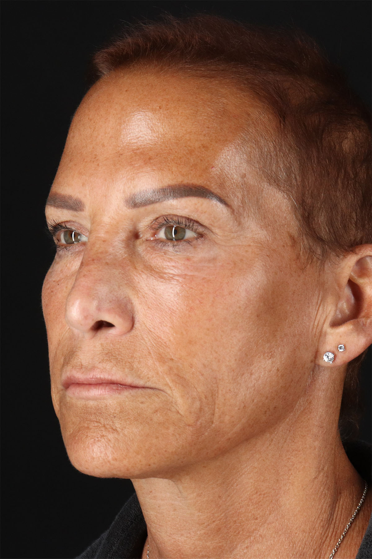 CO2 Laser Before & After Patient #2878