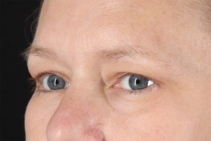 Eyelid Surgery Before & After Patient #2879
