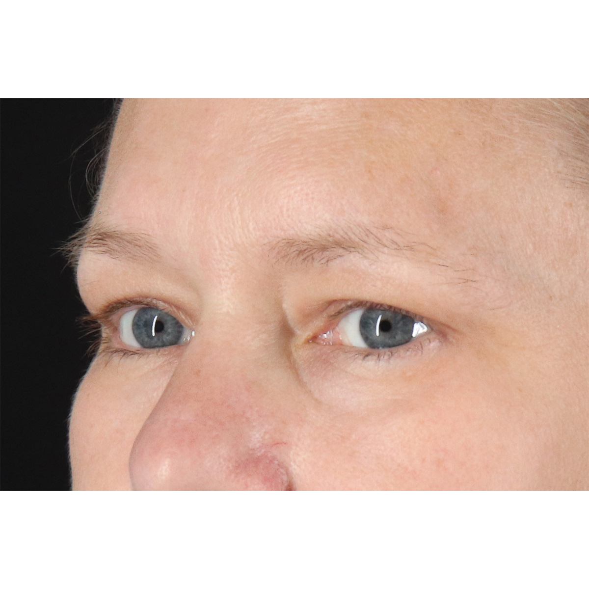 Eyelid Surgery Before & After Patient #2879