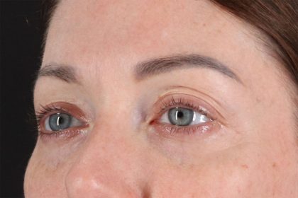 Eyelid Surgery Before & After Patient #2882