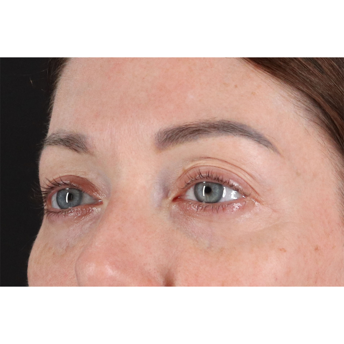 Eyelid Surgery Before & After Patient #2882