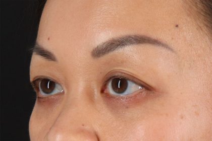 Eyelid Surgery Before & After Patient #2883