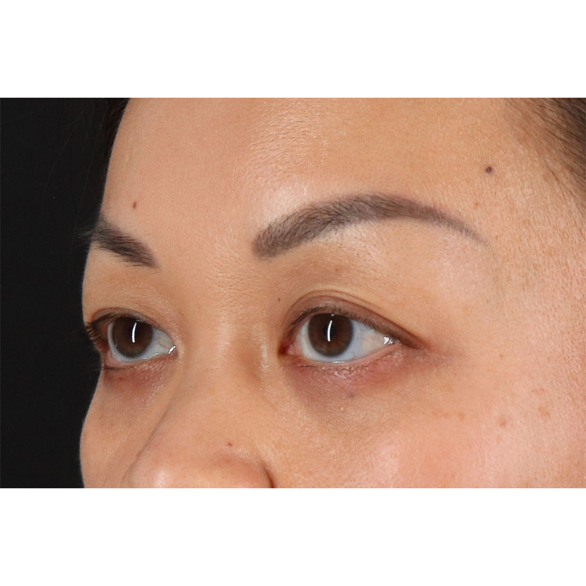 Eyelid Surgery Before & After Patient #2883