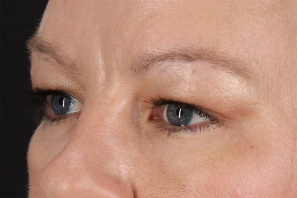 Eyelid Surgery Before & After Patient #2885