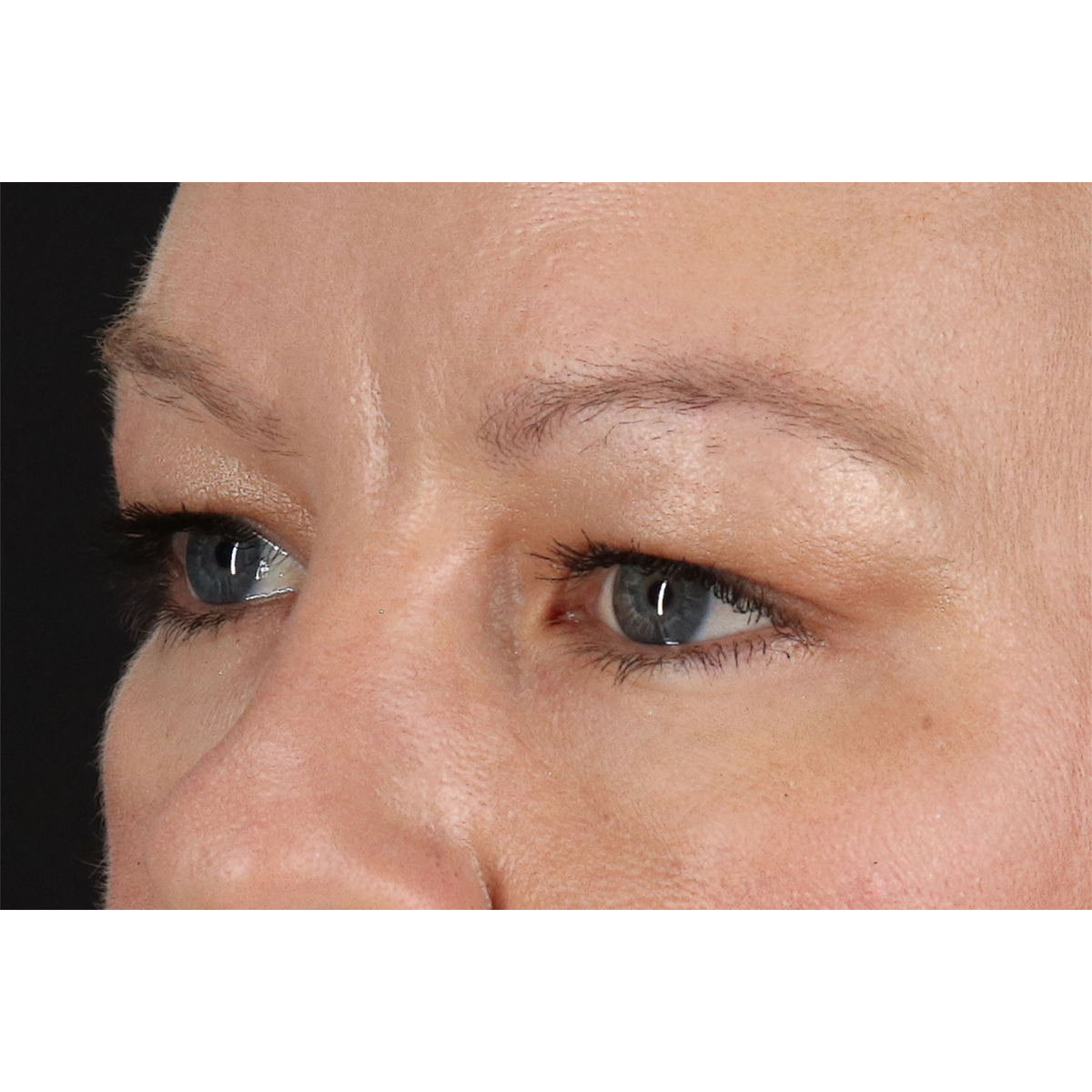 Eyelid Surgery Before & After Patient #2885
