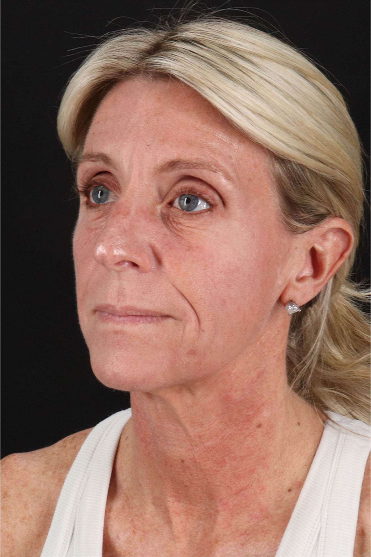 Structural Fat Grafting Before & After Patient #3650