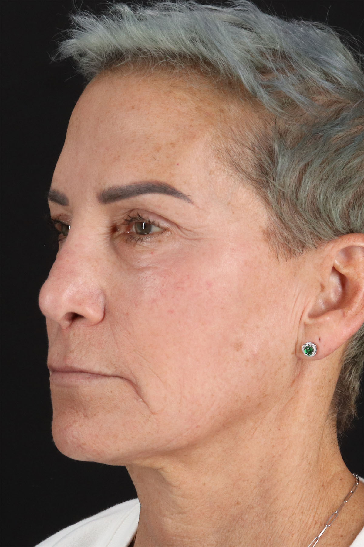 CO2 Laser Before & After Patient #2878