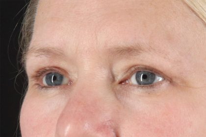 Eyelid Surgery Before & After Patient #2879