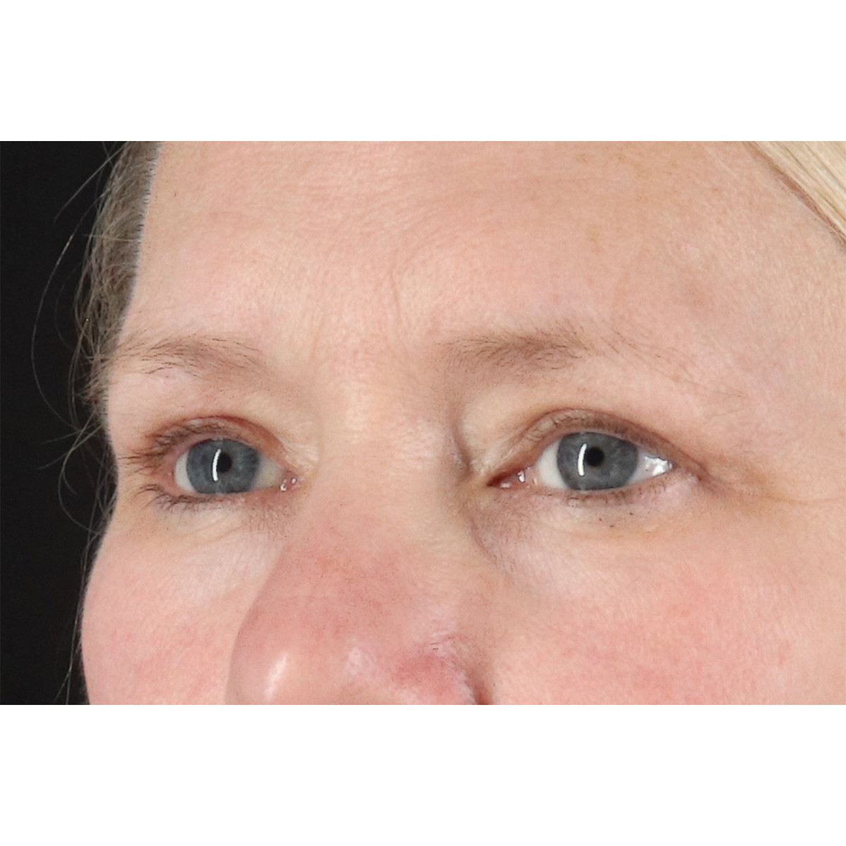 Eyelid Surgery Before & After Patient #2879