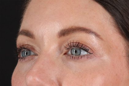 Eyelid Surgery Before & After Patient #2882