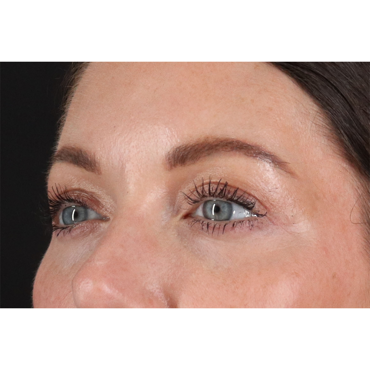 Eyelid Surgery Before & After Patient #2882