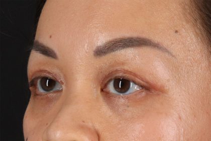 Eyelid Surgery Before & After Patient #2883