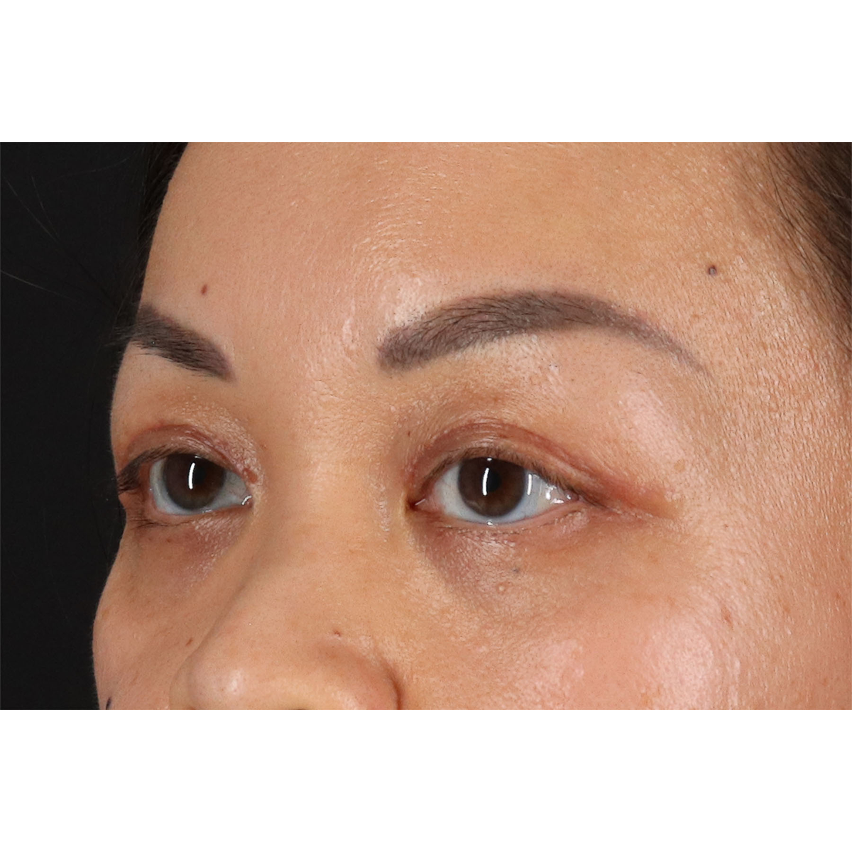 Eyelid Surgery Before & After Patient #2883