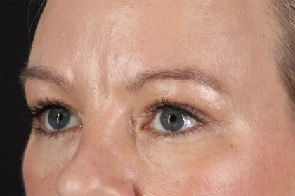 Eyelid Surgery Before & After Patient #2885