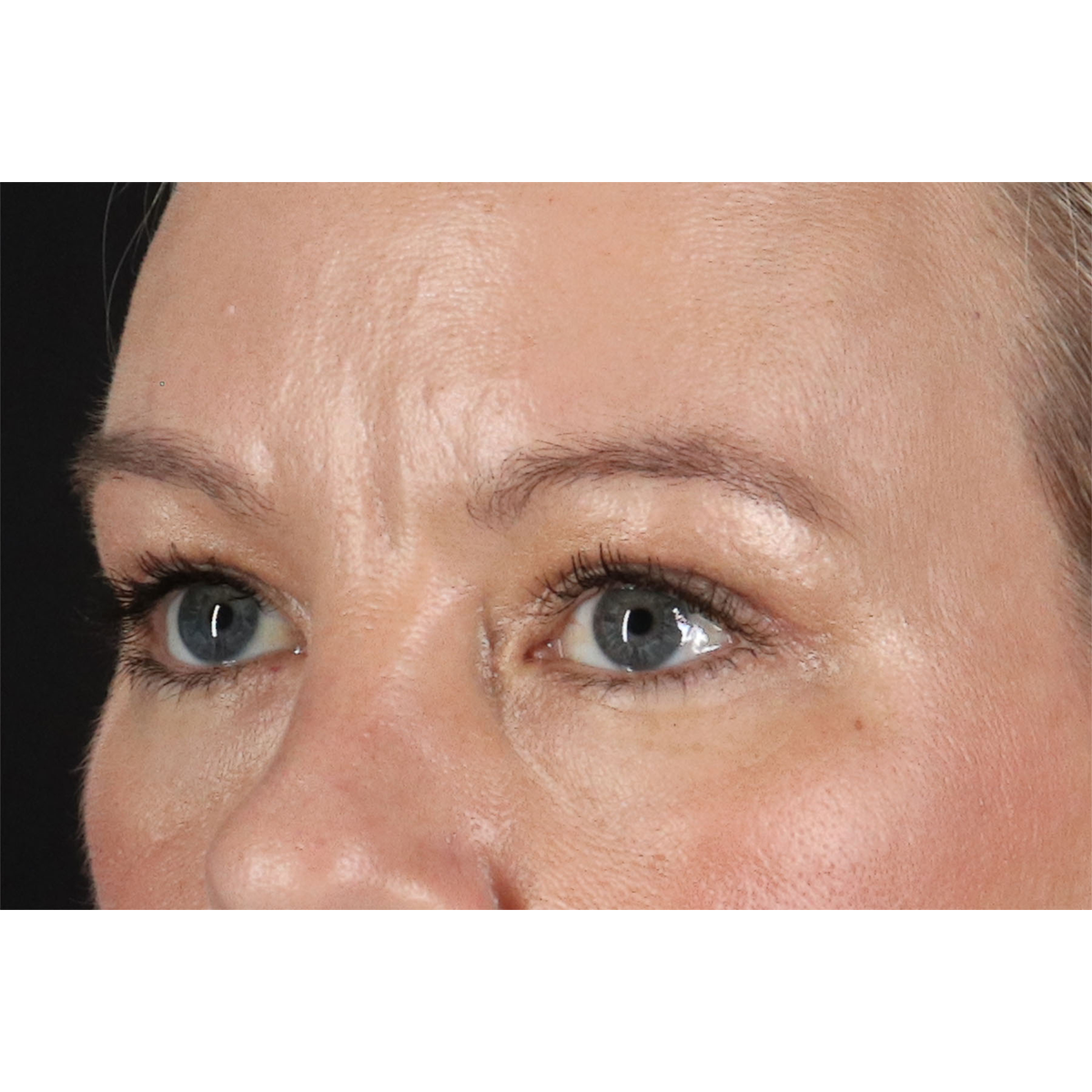 Eyelid Surgery Before & After Patient #2885
