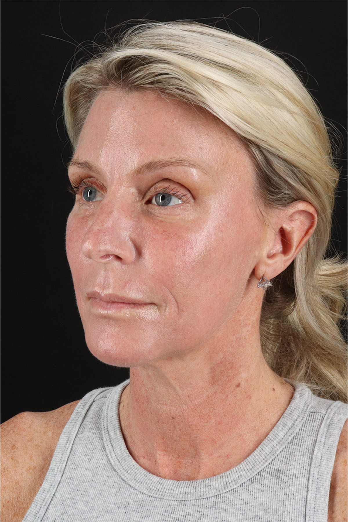 Structural Fat Grafting Before & After Patient #3650