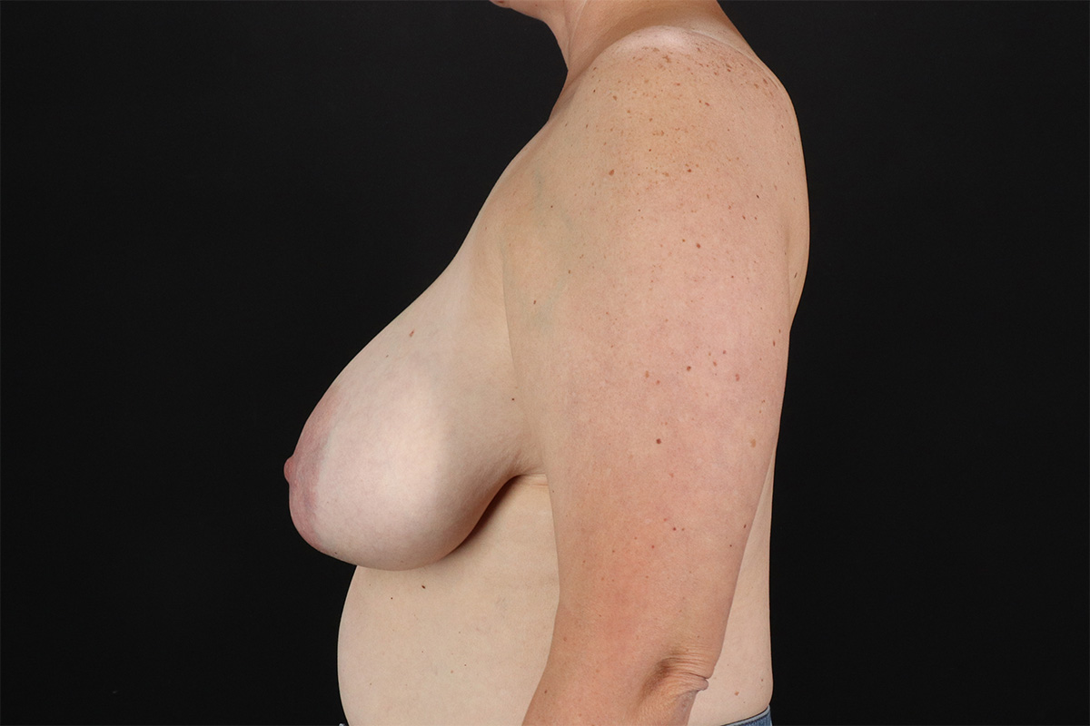 Breast Reduction with Lift Before & After Patient #2877