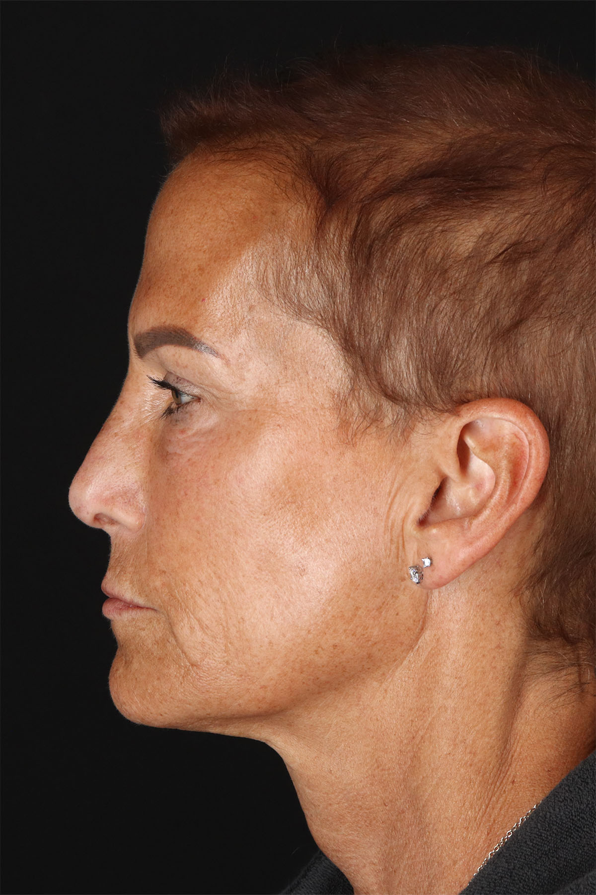CO2 Laser Before & After Patient #2878
