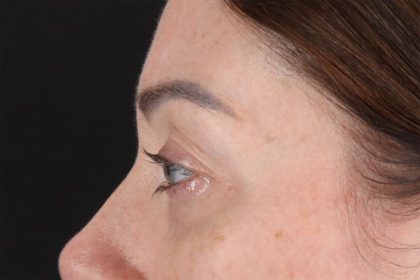 Eyelid Surgery Before & After Patient #2882