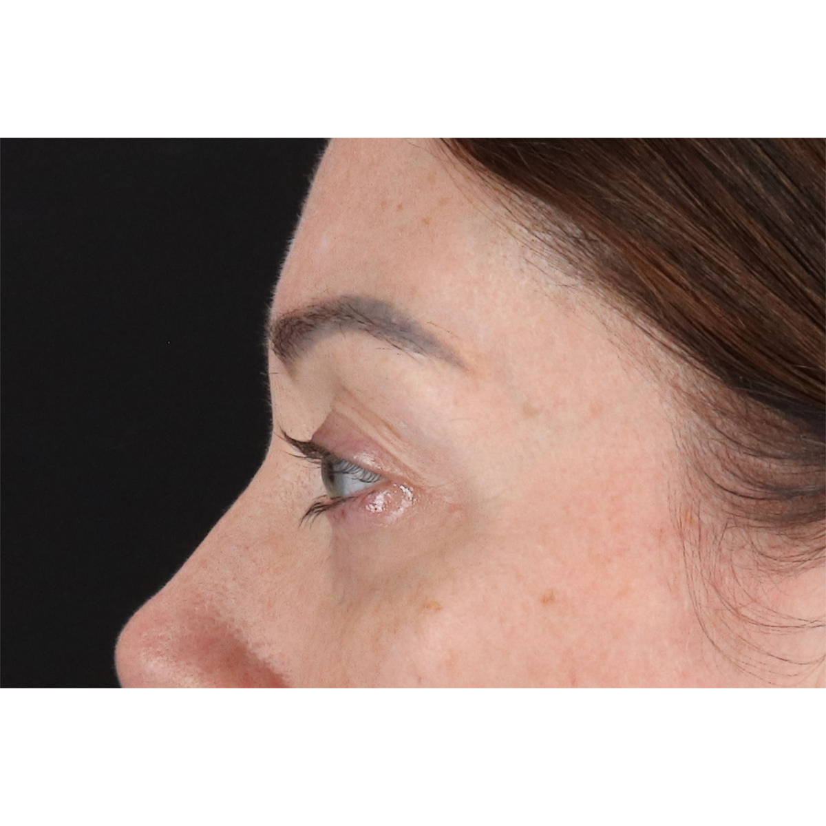 Eyelid Surgery Before & After Patient #2882
