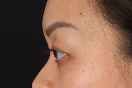 Eyelid Surgery Before & After Patient #2883