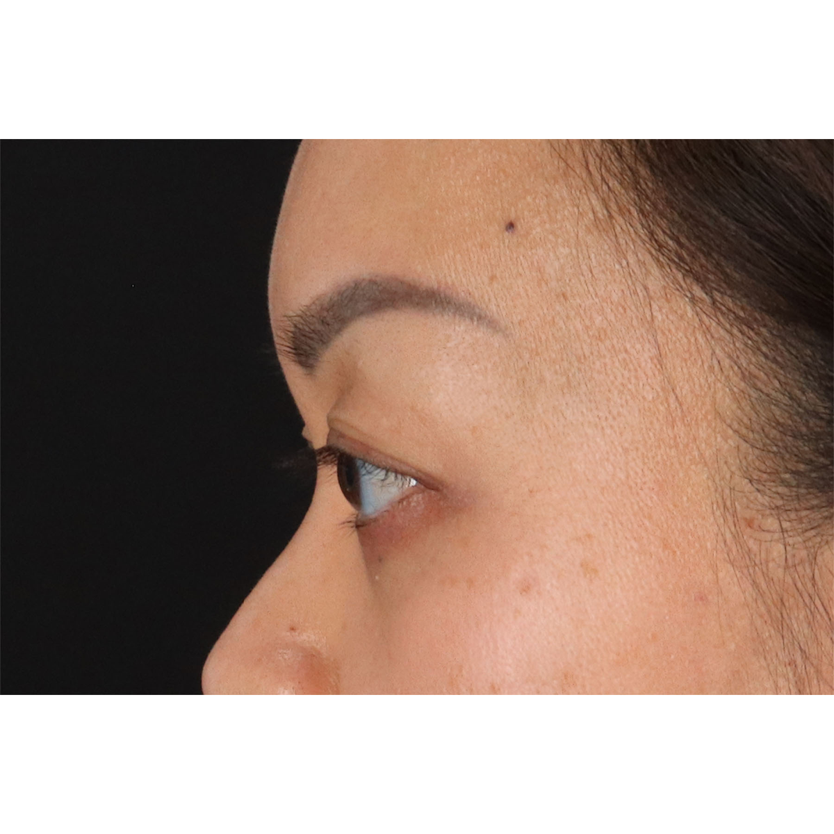 Eyelid Surgery Before & After Patient #2883