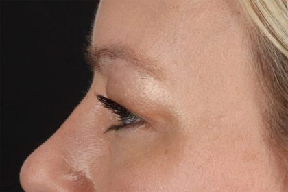 Eyelid Surgery Before & After Patient #2885