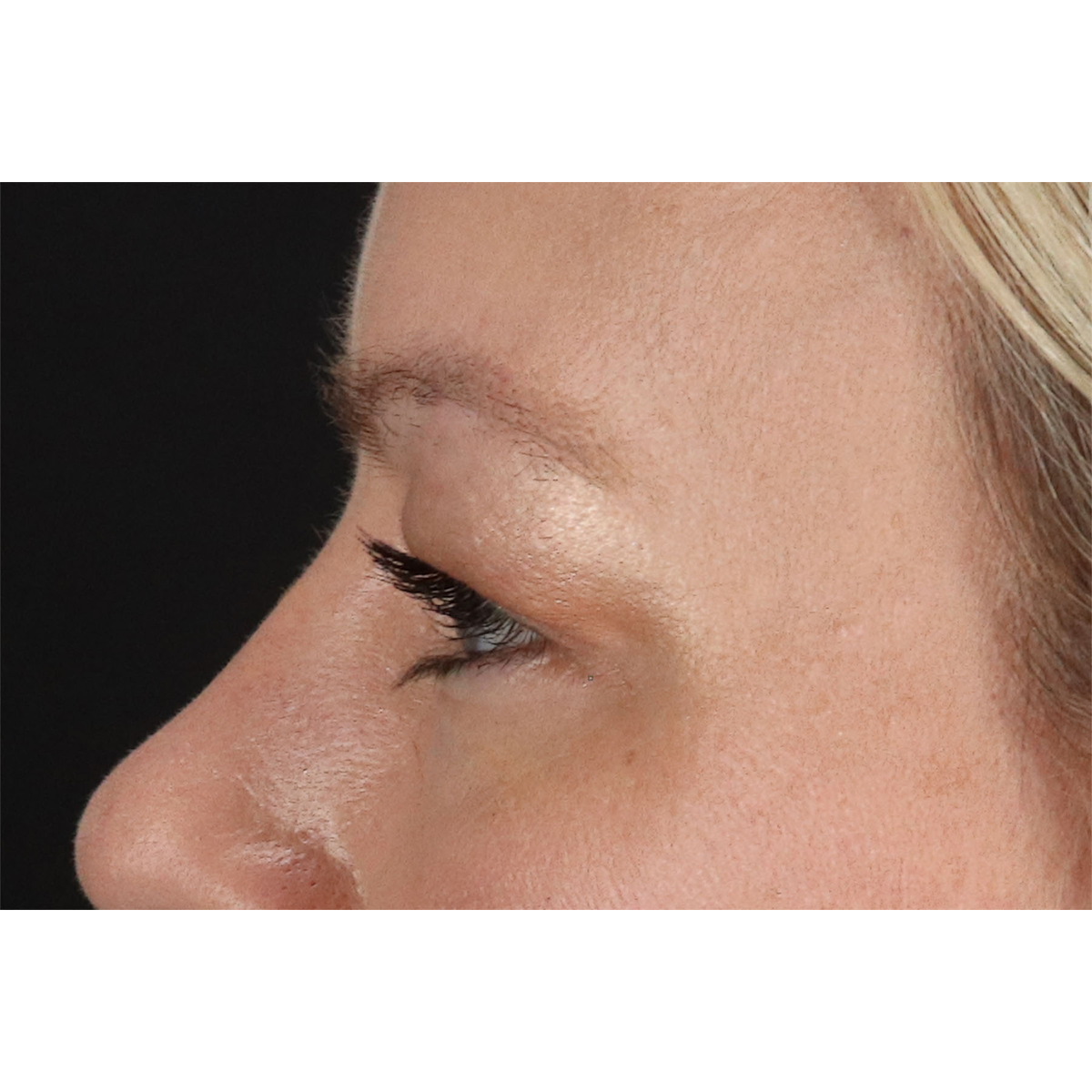 Eyelid Surgery Before & After Patient #2885