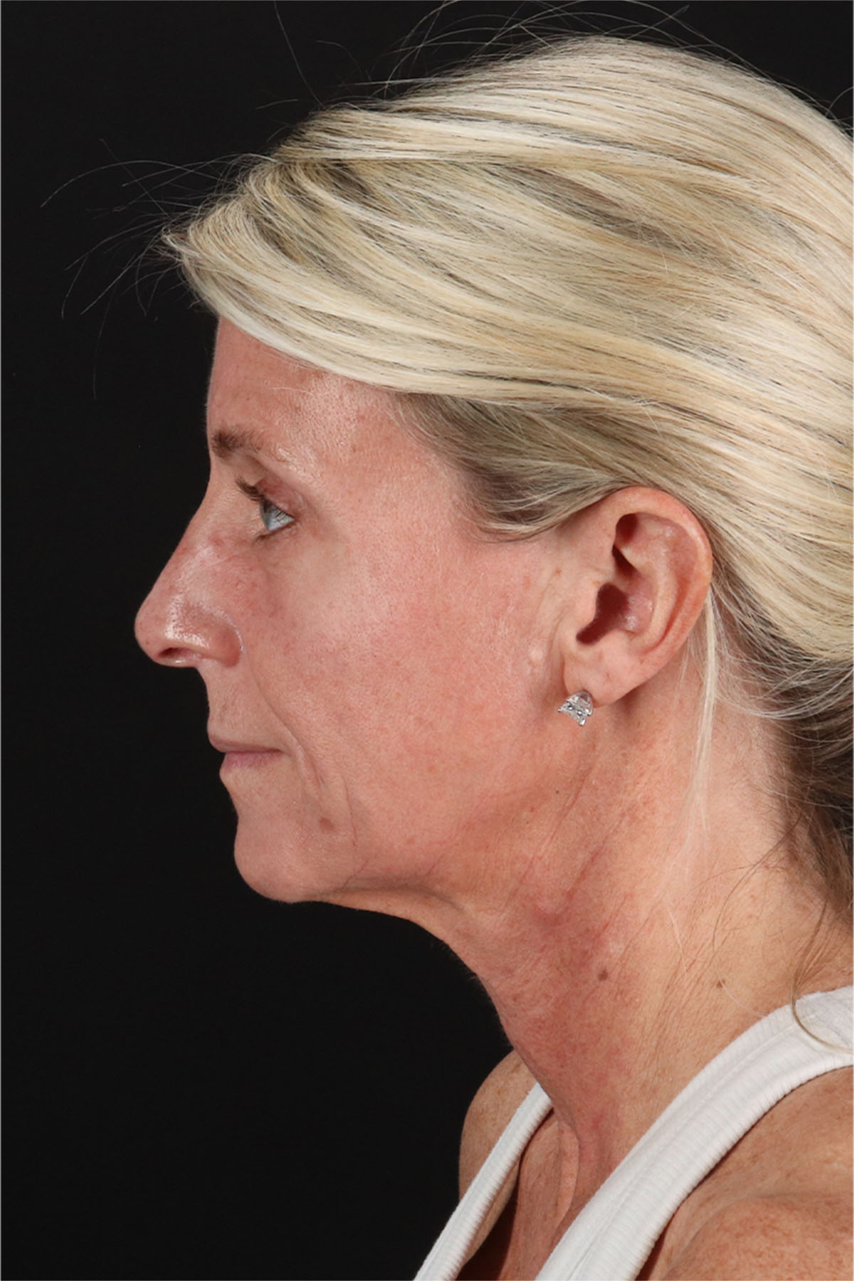 Structural Fat Grafting Before & After Patient #3650