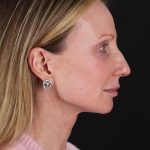 Face Lift Before & After Patient #3219