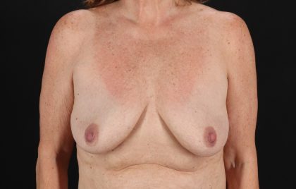Implant Revision Before & After Patient #3221