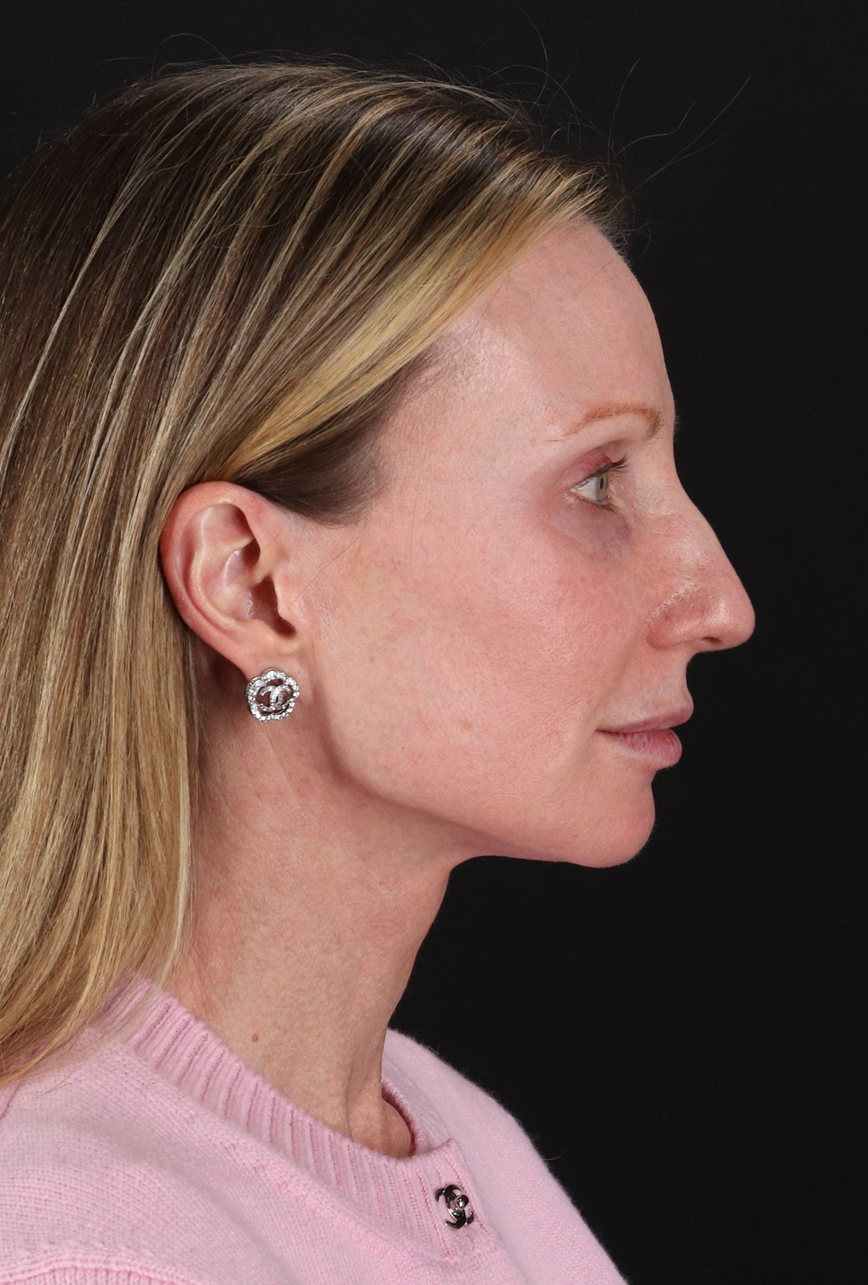 Face Lift Before & After Patient #3219