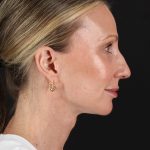 Face Lift Before & After Patient #3219